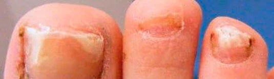 Alterações nas unhas ilustrando o cuidado com micose